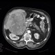 Hepatocellular carcinoma, HCC: CT - Computed tomography